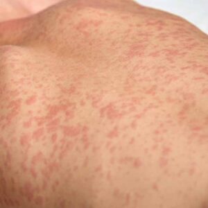 kizamiga yakalandiktan 10 yil sonra hayatini kaybetti nedeni tum ailelere ornek oldu JPS7mTAs