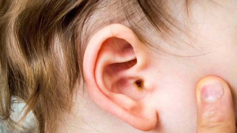 uzmani uyardi orta kulak iltihabi cocuklarda gecici isitme kaybina neden olabilir PYtJGBMg